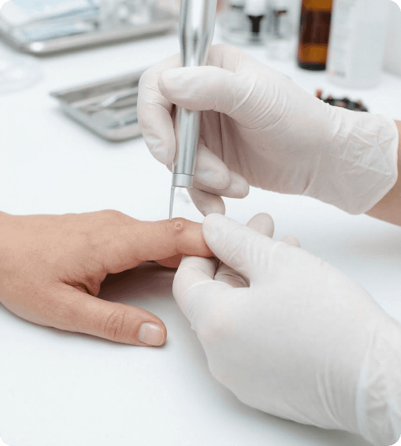 Ryški, iš arti nuotrauka, kurioje užfiksuotas tikslinis dermatologinis įrankis, kurį gydytojas naudoja mažam, lokalizuotam odos pažeidimui paciento odos paviršiuje gydyti arba pašalinti.
