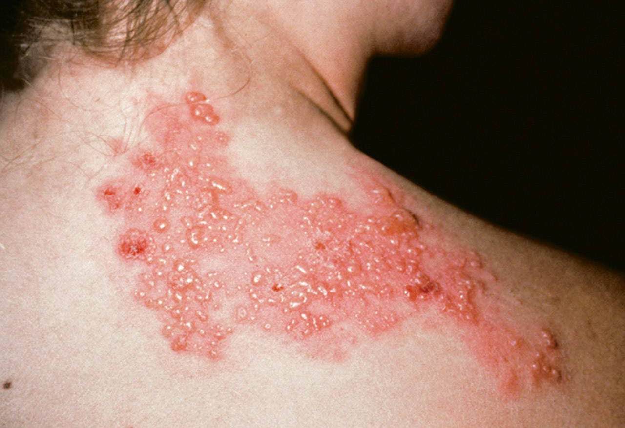 Shingles rash: a band of blisters with redness on one side of the body